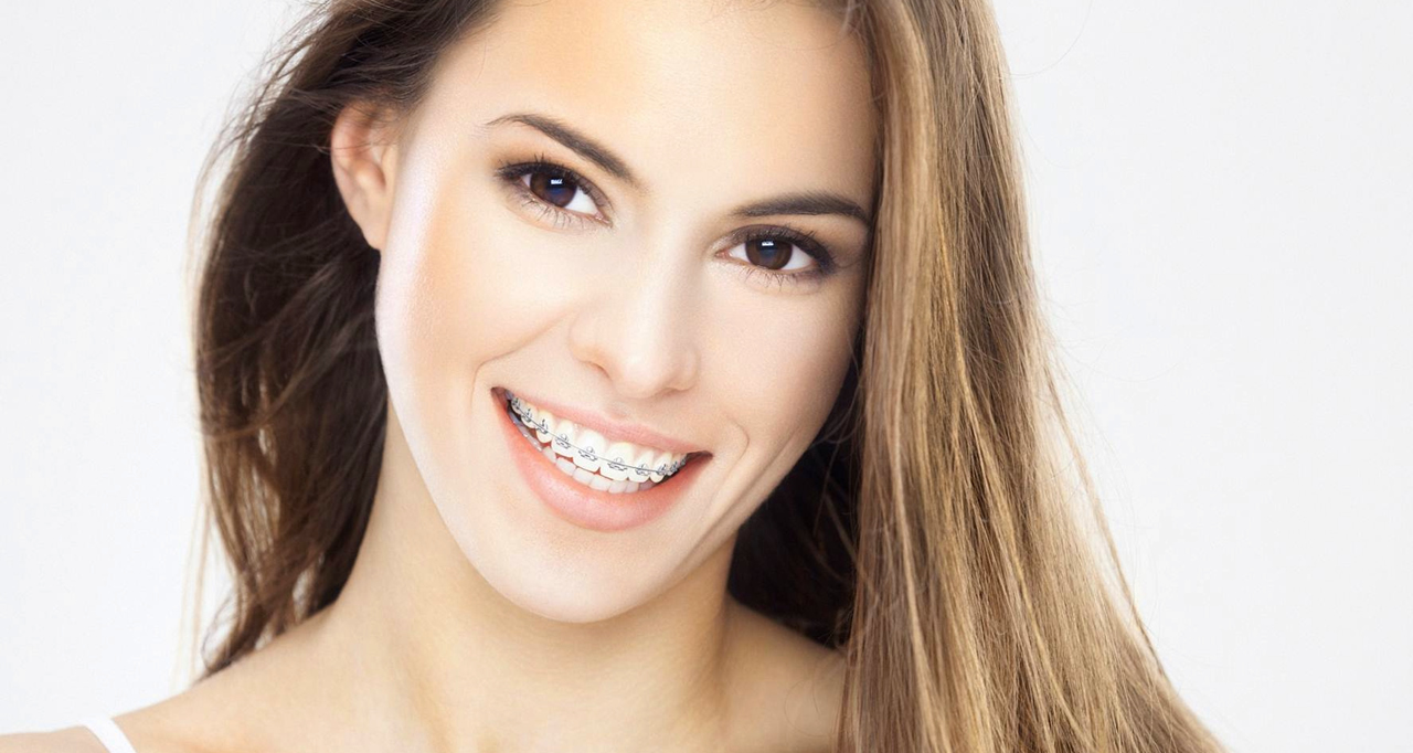 Metal braces treatment in Nicosia, Cyprus Dr Tamassios Orthodontics
