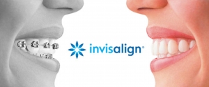 invisalign-Clear Aligners